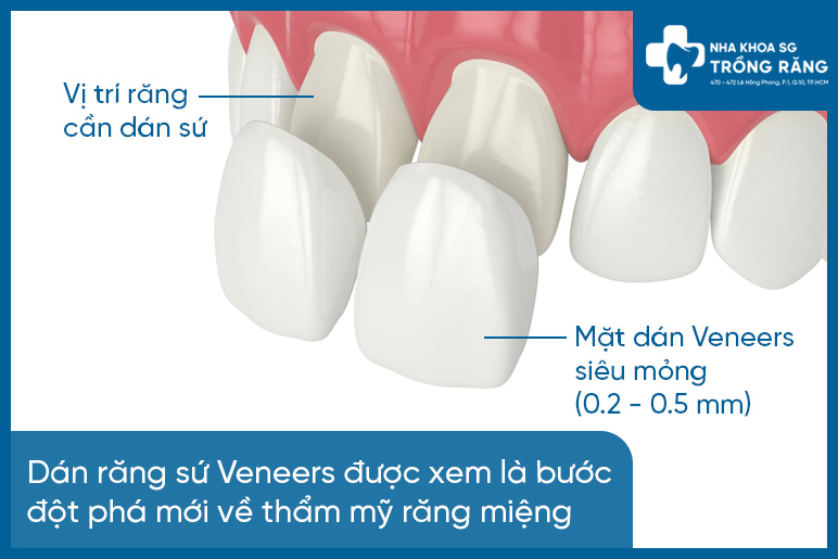 Dán răng sứ veneer - tất tần tật thông tin cần biết