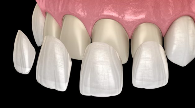 Dán răng sứ veneer là gì? Cần lưu ý gì sau khi thực hiện?